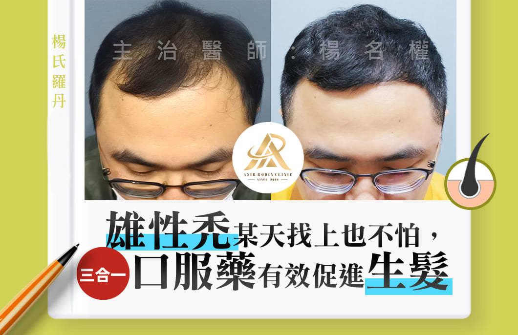 【複合式生髮】雄性禿某天找上也不怕，三合一口服藥有效促進生髮